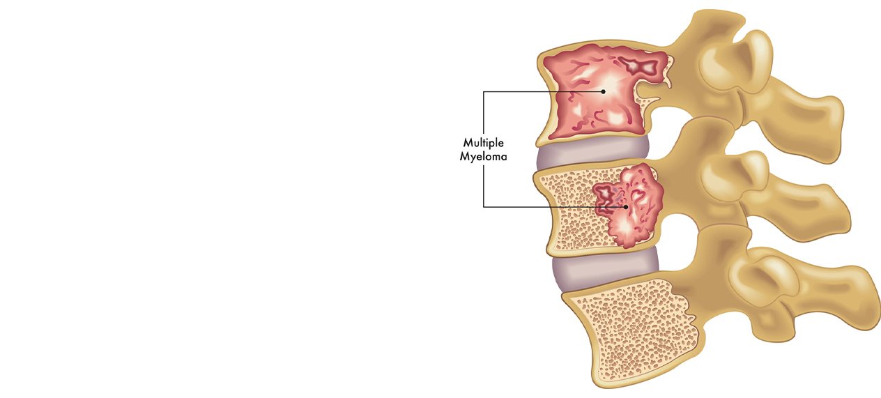 What Is Multiple Myeloma? Understanding Symptoms And Treatment Options